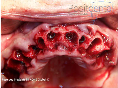 Mise en charge immédiate en chirurgie guidée   positdental 023 pxeeva - Eugenol