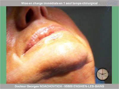 Mise en charge immédiate en chirurgie guidée positdental 003 mykaaz - Eugenol