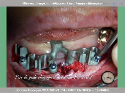 Mise en charge immédiate en chirurgie guidée positdental 004 uxznt1 - Eugenol