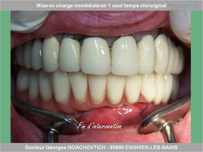 Mise en charge immédiate en chirurgie guidée positdental 010 w1xfo8 - Eugenol