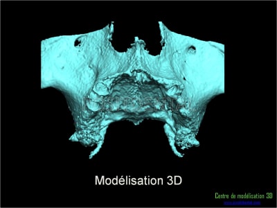 Mise en charge immédiate implant dentaire 013 ew2odr - Eugenol