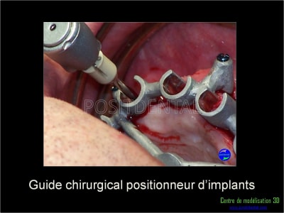 Mise en charge immédiate implant dentaire 037 tmnfyu - Eugenol