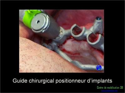 Mise en charge immédiate implant dentaire 039 ymosi7 - Eugenol