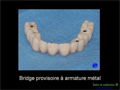 Mise en charge immédiate implant dentaire 045 e0lzhr - Eugenol