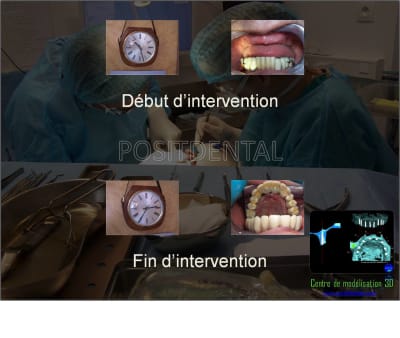 Mise en charge immédiate implant dentaire 050 bmhjmp - Eugenol