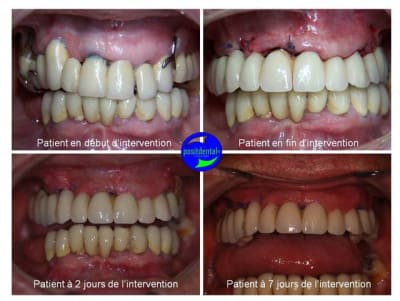 Mise en charge imm diate - Eugenol