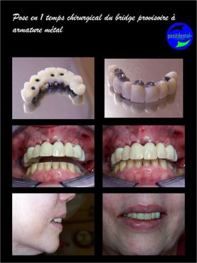 Mise en charge imm diate bridge provisoire sur implants 6 eeywff - Eugenol