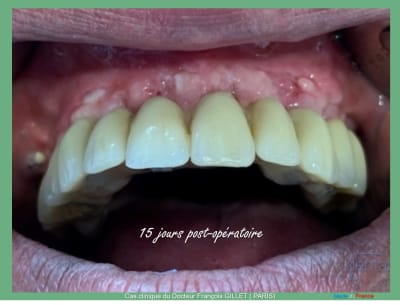 Misen en charge immédiate implants et dents en 1 seule intervention 004 mr15h9 - Eugenol