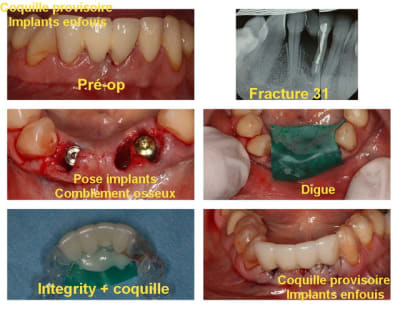 Montage 32 42 implants 2  vde50k - Eugenol