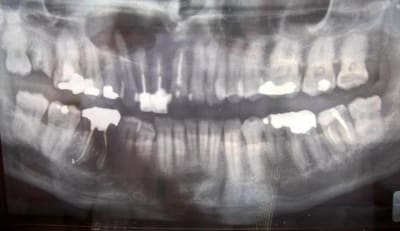 Opt rpzlox - Eugenol