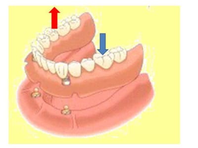 Pacsi sur attachements czmuhh - Eugenol