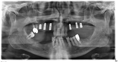 Pano sirona zrcm9l - Eugenol