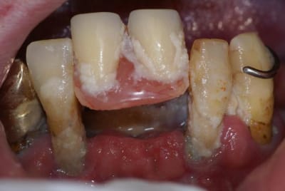 Pap r sine soins actuels bokell - Eugenol