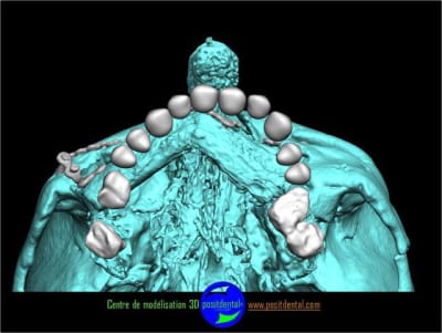 Positdental 5 tjecgd - Eugenol