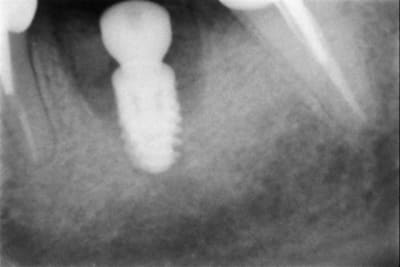 Post op gglhbi - Eugenol