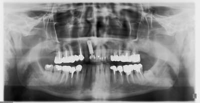 Post op y8jcfk - Eugenol