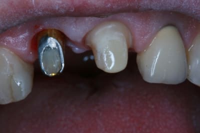 Pr  op couronnes 11 21 006 rwkvgc - Eugenol