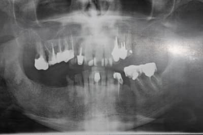 Pano avant ddxpna - Eugenol