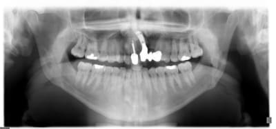 Pano implant 21 akctyd - Eugenol