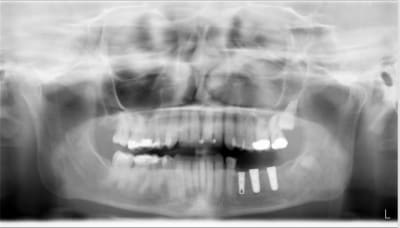 Pano post op g5efcv - Eugenol