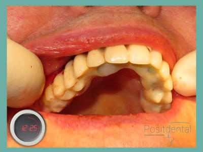 Positdental mise en charge immédiate 005 dxpxz9 - Eugenol