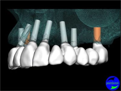 Positdental 007 mirkc6 - Eugenol