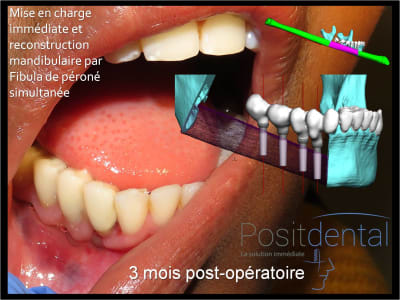 Positdental guide de coupe fibula ocf1wg - Eugenol