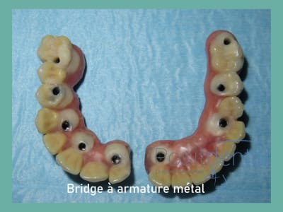 Positdental mise en charge immédiate 013 s08csw - Eugenol