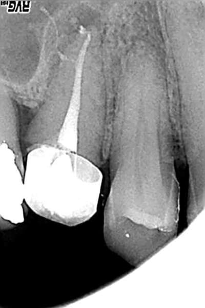 Postop pvlfgk - Eugenol