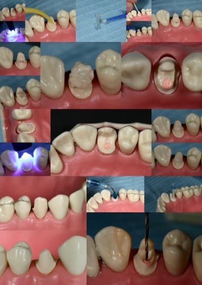 Premolaire wi4lv9 - Eugenol