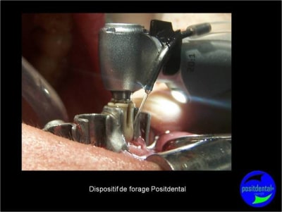Protocole mci post extractionnelle positdental 015 p0bap8 - Eugenol