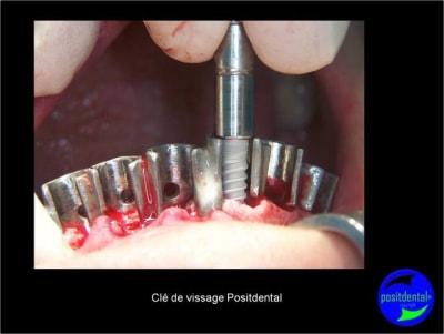 Protocole mci post extractionnelle positdental 016 ikywzi - Eugenol