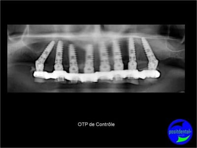 Protocole mci post extractionnelle positdental 021 dghq6l - Eugenol