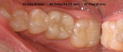 Q4  post op  2 ga47o1 - Eugenol