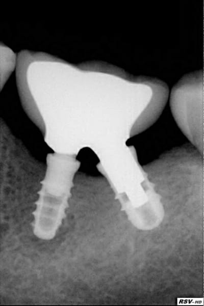 Rx couronne en place be5lkf - Eugenol