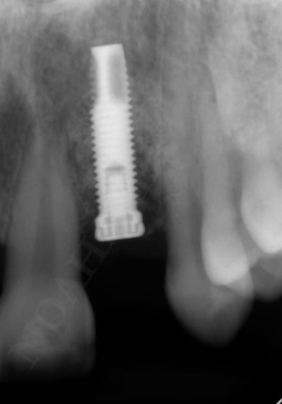 Rx implant fptcf5 - Eugenol