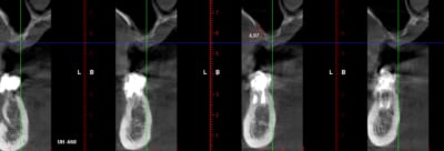 Sinus qosr0w - Eugenol