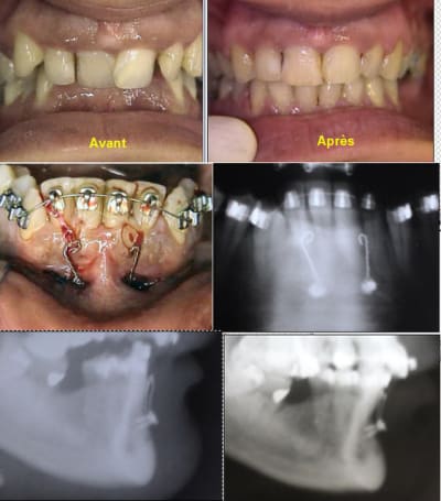 Solene   vis symphysaires athwrn - Eugenol