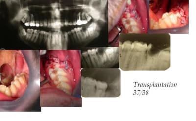 Transplant zhgzb5 - Eugenol