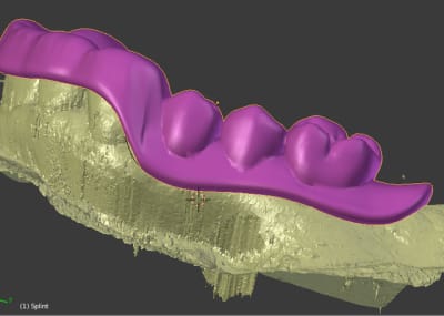 Tooth guide side b5cp7y - Eugenol