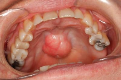 Torus palatin d804oc - Eugenol