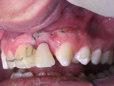 Trauma 25 beutw6 - Eugenol