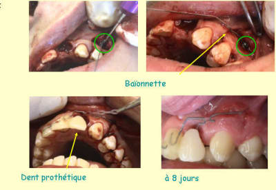 Trauma 2 y3k1is - Eugenol