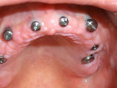 Vidal implants 002 chpxt7 - Eugenol