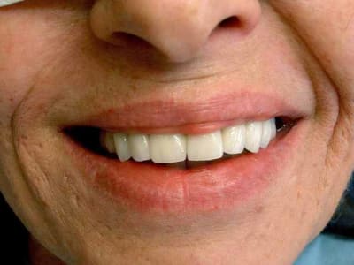 Vidal implants 012 dfq4u2 - Eugenol