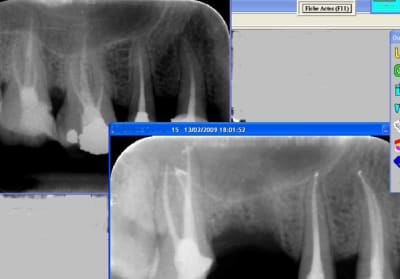 Vive l endo bis ohqf4d - Eugenol