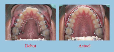 Vue o - Eugenol