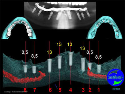Wax up 3d positdental 10 xgrbfp - Eugenol