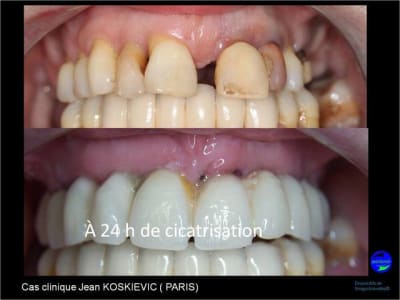 Wax up 3d positdental 2 lfgnpl - Eugenol