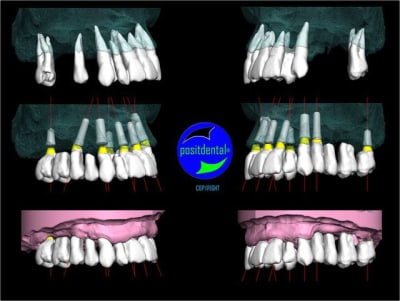 Wax up 3d positdental 6 gjokn0 - Eugenol